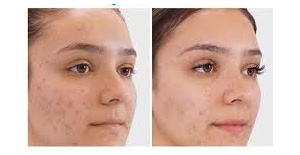 traitement acnee photomodulation amavida