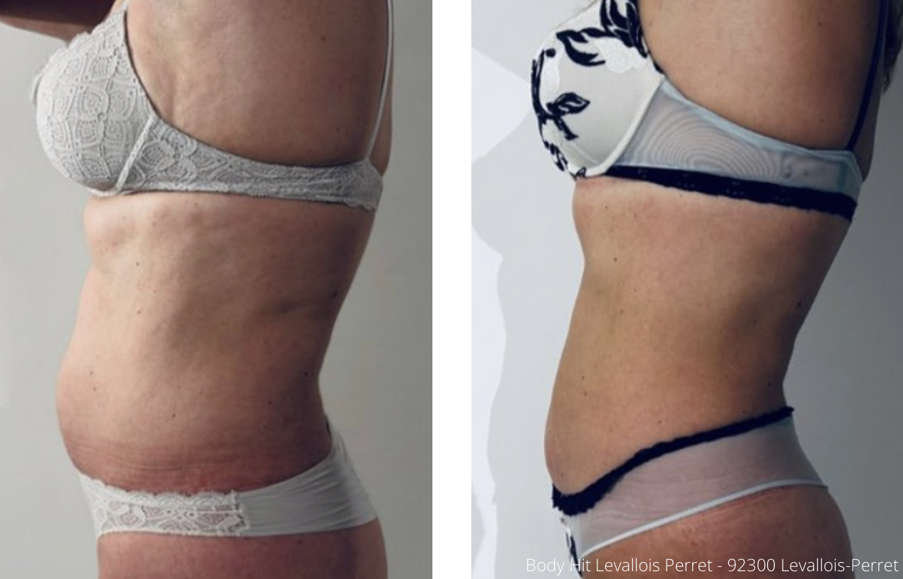 Cryolipolyse Augmentée 1 séance ventre poignees damour 01