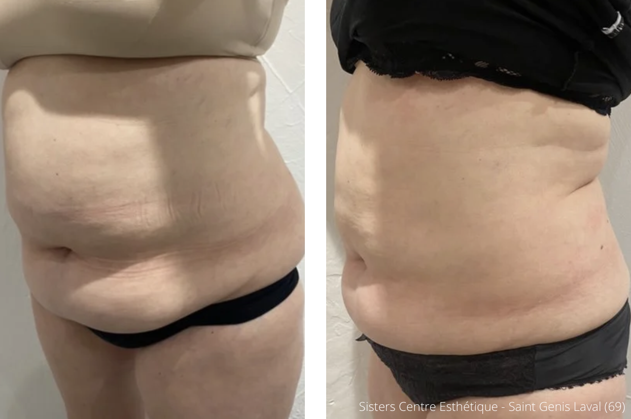 Cryolipolyse Augmentée 1 séance ventre poignees damour 02
