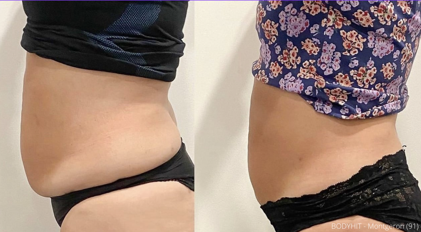 Cryolipolyse augmentee et laser diode 02