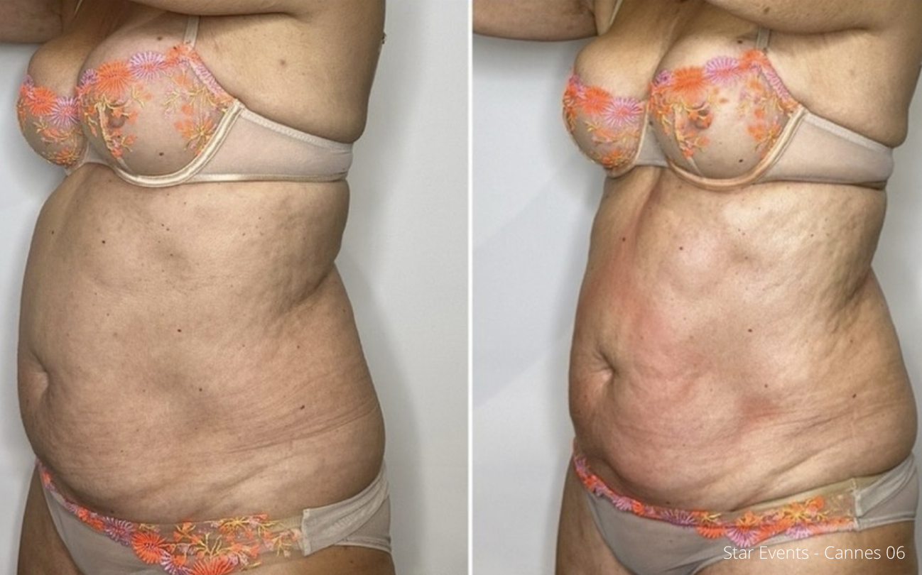 Cryolipolyse augmentee et laser diode 03