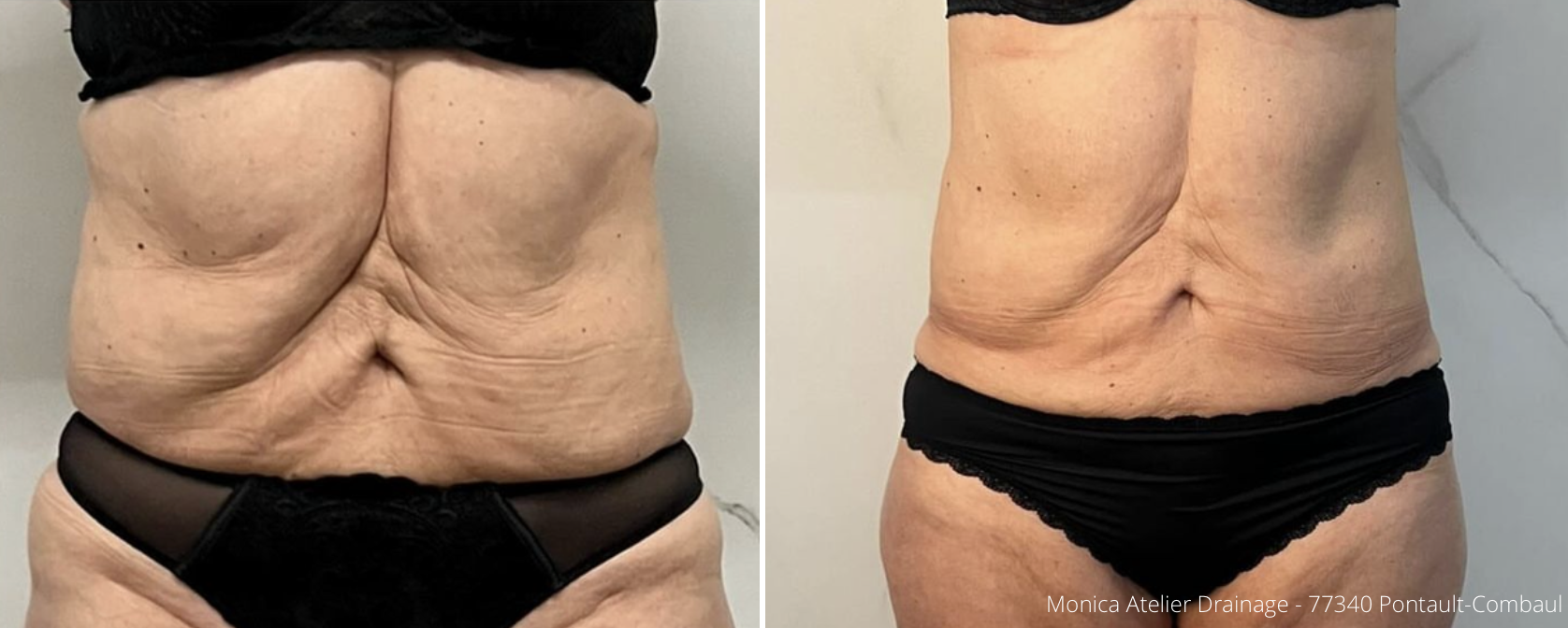 Cryolipolyse augmentee et laser diode 04