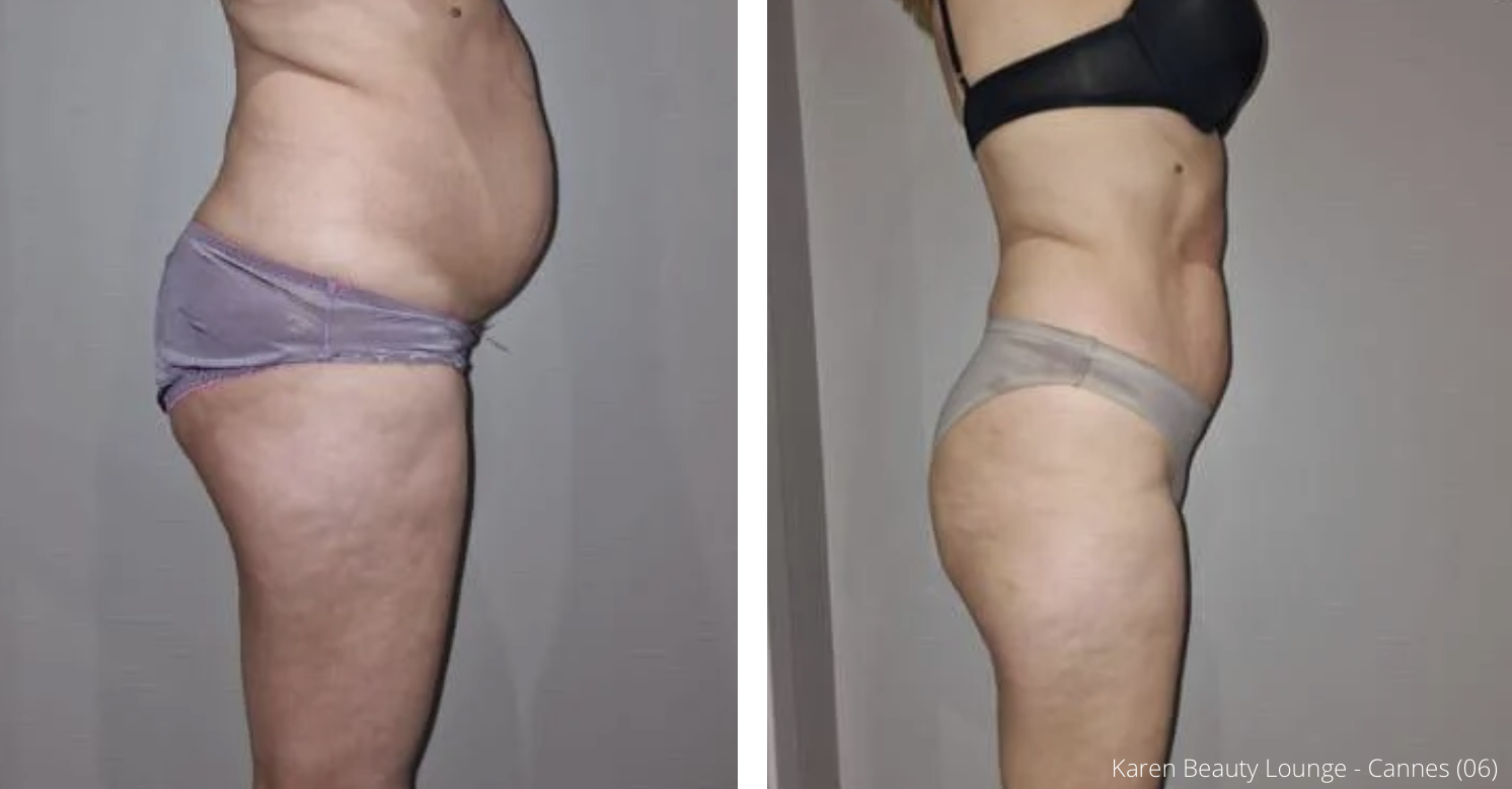Cryolipolyse augmentee et laser diode 1 séance 01