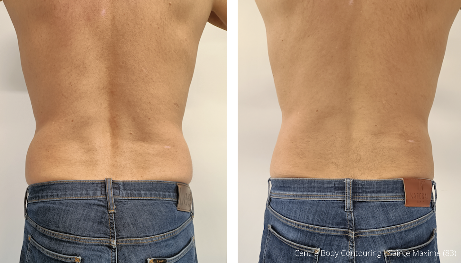 Cryolipolyse poignees damour 1 seance