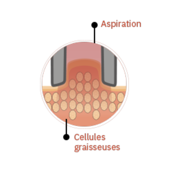 aspiration fibroblastes